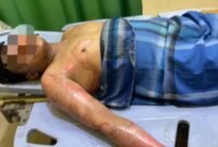 Korban yang merupakan pengurus Ponpes An Nur di Kecamatan Hinai alami luka bakar yang disebabkan oleh teman dekatnya, Sabtu (05/10)
